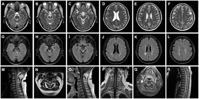 Case report: Overlap syndrome of neuromyelitis optica spectrum disorder with anti-Argonaute antibodies